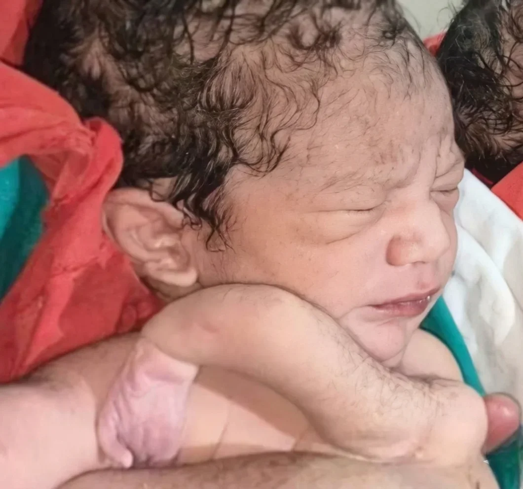 कुदरत का करिश्मा: छतरपुर में जन्मे 4 हाथ और 4 पैर वाले दुर्लभ बच्चे ने सबको चौंकाया